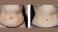 Tummy Tuck