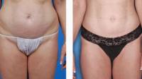 Liposuction